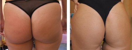 Впадинки на ягодицах