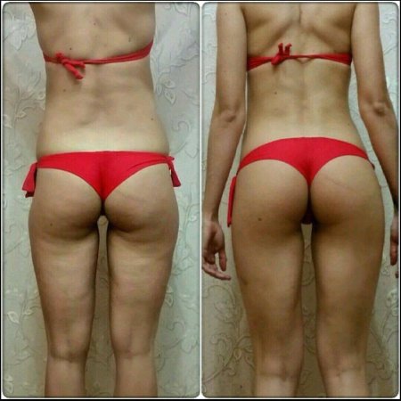 Складка под ягодицей