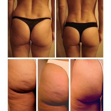 Целлюлит до и после массажа