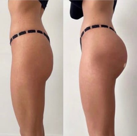 Увеличение ягодиц