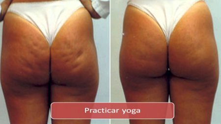 Ямочки на ягодицах