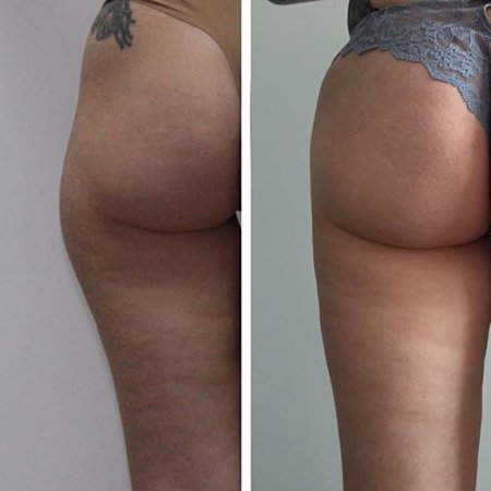 Липосакция Липоскульптурирование