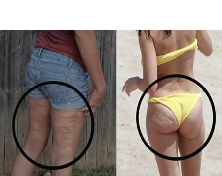 Целлюлит на ягодицах у худых