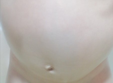 У ребенка торчит пупок