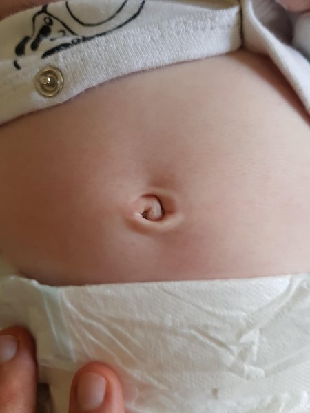 Грыжа у ребенка пупочная