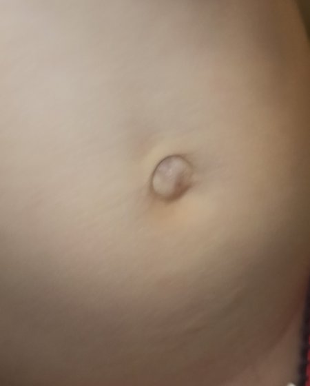 Пупочная грыжа