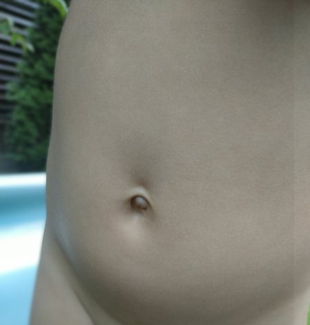 Невправимая пупочная грыжа