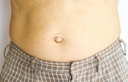 Пупочная грыжа