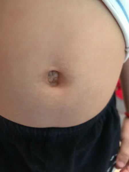 Хоботообразная пупочная грыжа