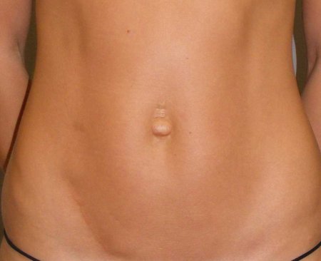 Пупочная грыжа лапароскопически