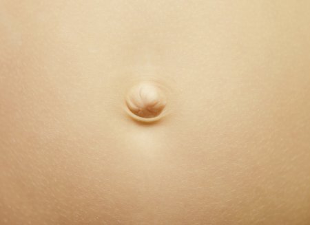 Пупочная грыжа