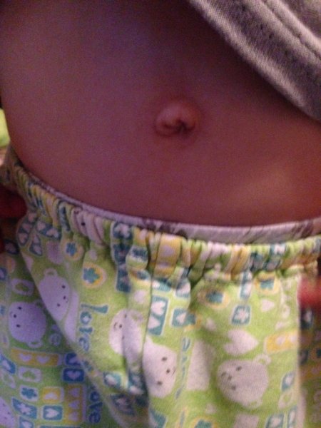 Образование в пупке у ребенка