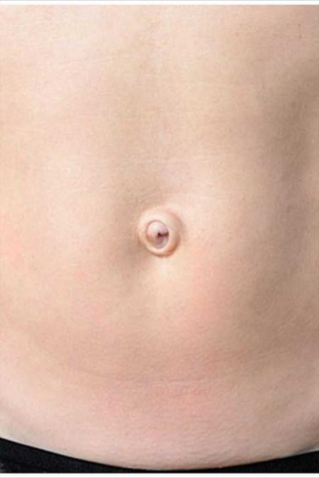 Хоботообразная пупочная грыжа