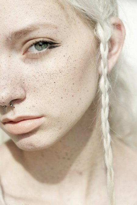 Кожно глазной альбинизм