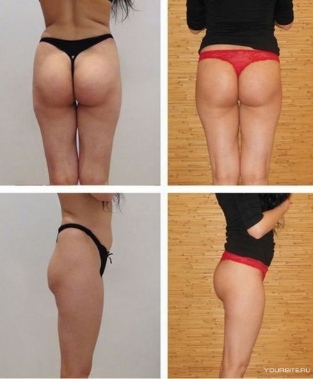 Плоские попы до и после