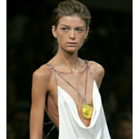 Анна Каролина Рестон анорексия