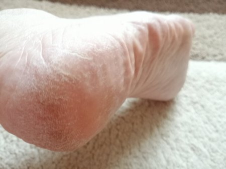 Нежные пяточки
