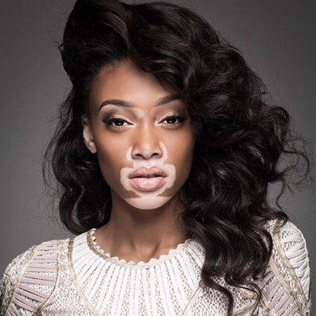 Витилиго Винни Харлоу