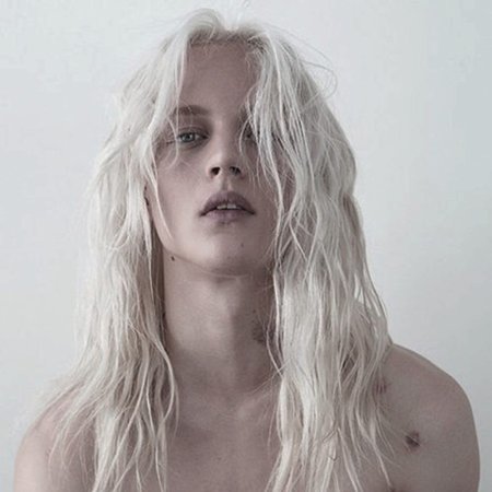 Дилан Фоскет альбинос