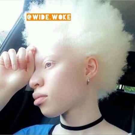 Альбиносы люди