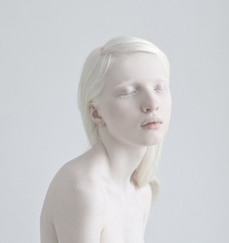 Амина Эпендиева альбинос