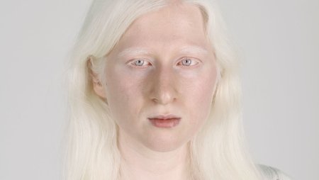 Окулокутанный альбинизм