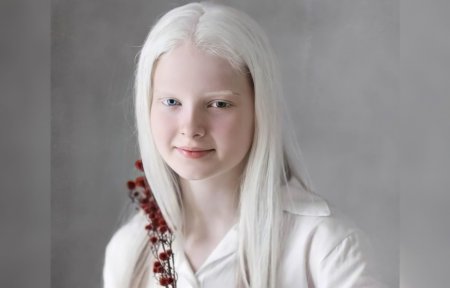 Амина Эпендиева альбинос