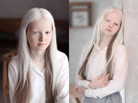 Амина Арсакова альбинос