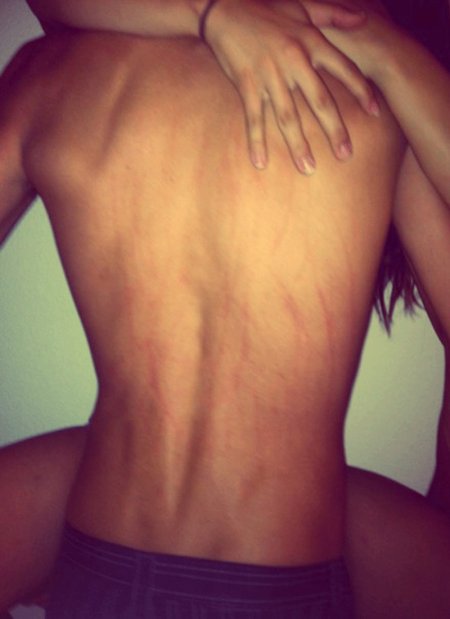 Сцарапиная спина парня