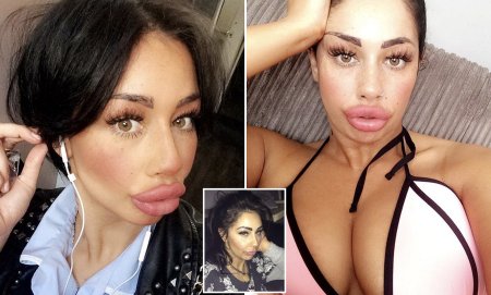 Накаченные силиконом губы