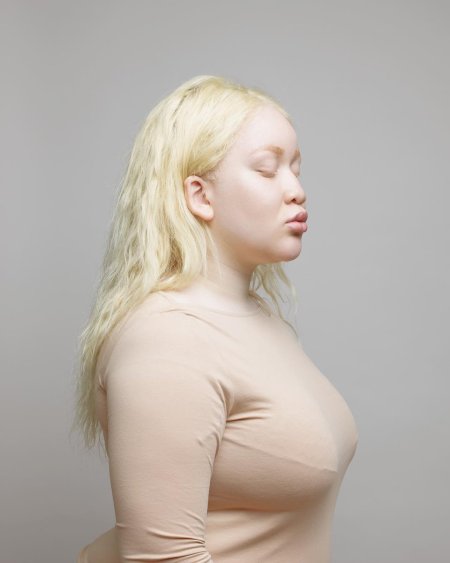 Альбиносы люди