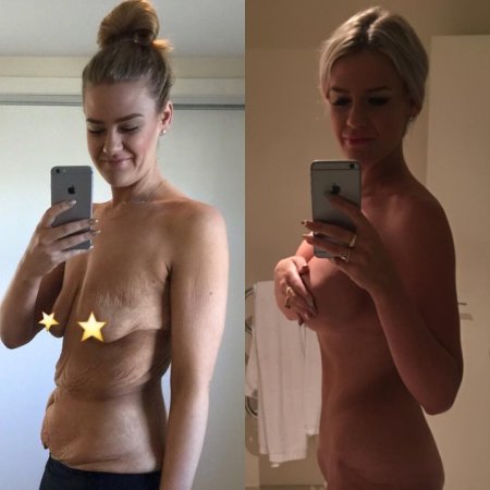 Титьки после похудения