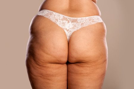 Толстые целлюлитные ляжки