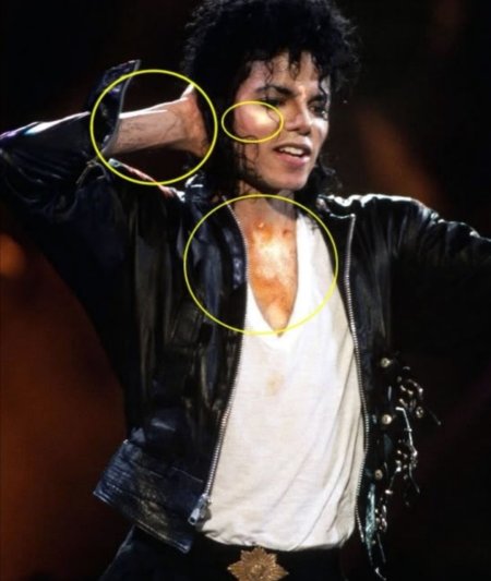 Витилиго Майкл Джексон витилиго