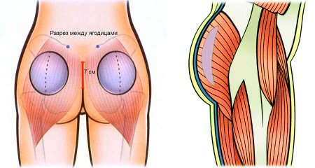 Пластика ягодиц глютеопластика