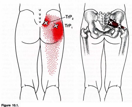 Миофасциальный синдром бедра