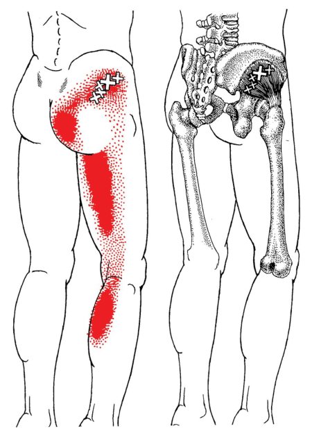 Триггерные точки ягодичной мышцы