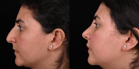 Ринопластика горбинки носа