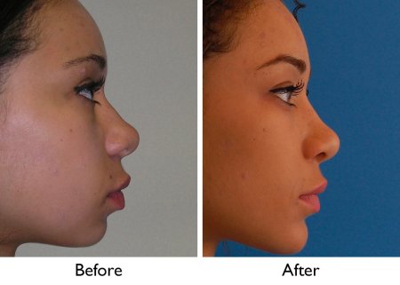 Ринопластика курносого носа