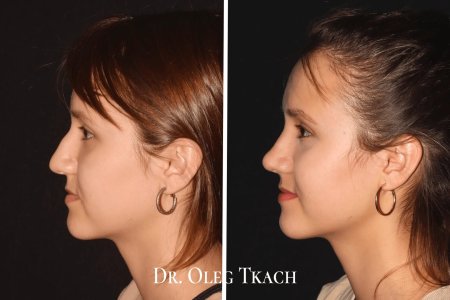 Хайбула камилович ринопластика