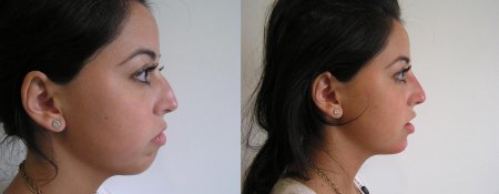 Ортогнатическая операция дистальный прикус