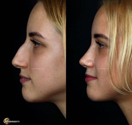 Мрочко игорь владимирович ринопластика