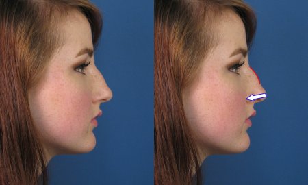 Нос с горбинкой