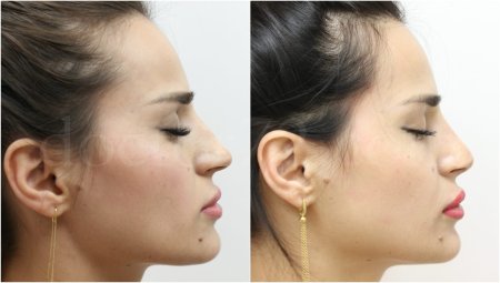 Ринопластика гайк бабаян