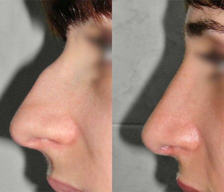 Ринопластика горбинки носа