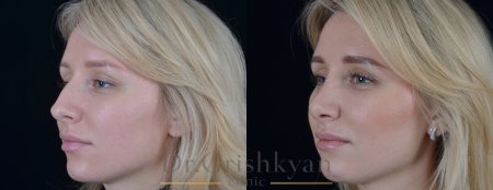 Ринопластика кончика носа