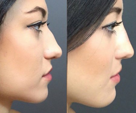 Нос с большой горбинкой