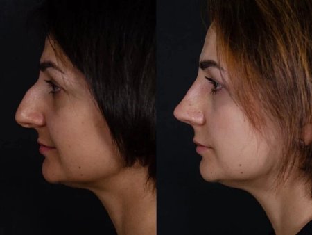 Нос с ярко выраженной горбинкой