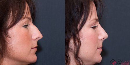 Ринопластика курносого носа