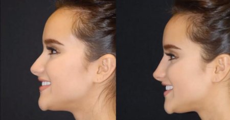 Ринопластика курносого носа